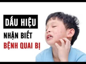 Bệnh Quai Bị